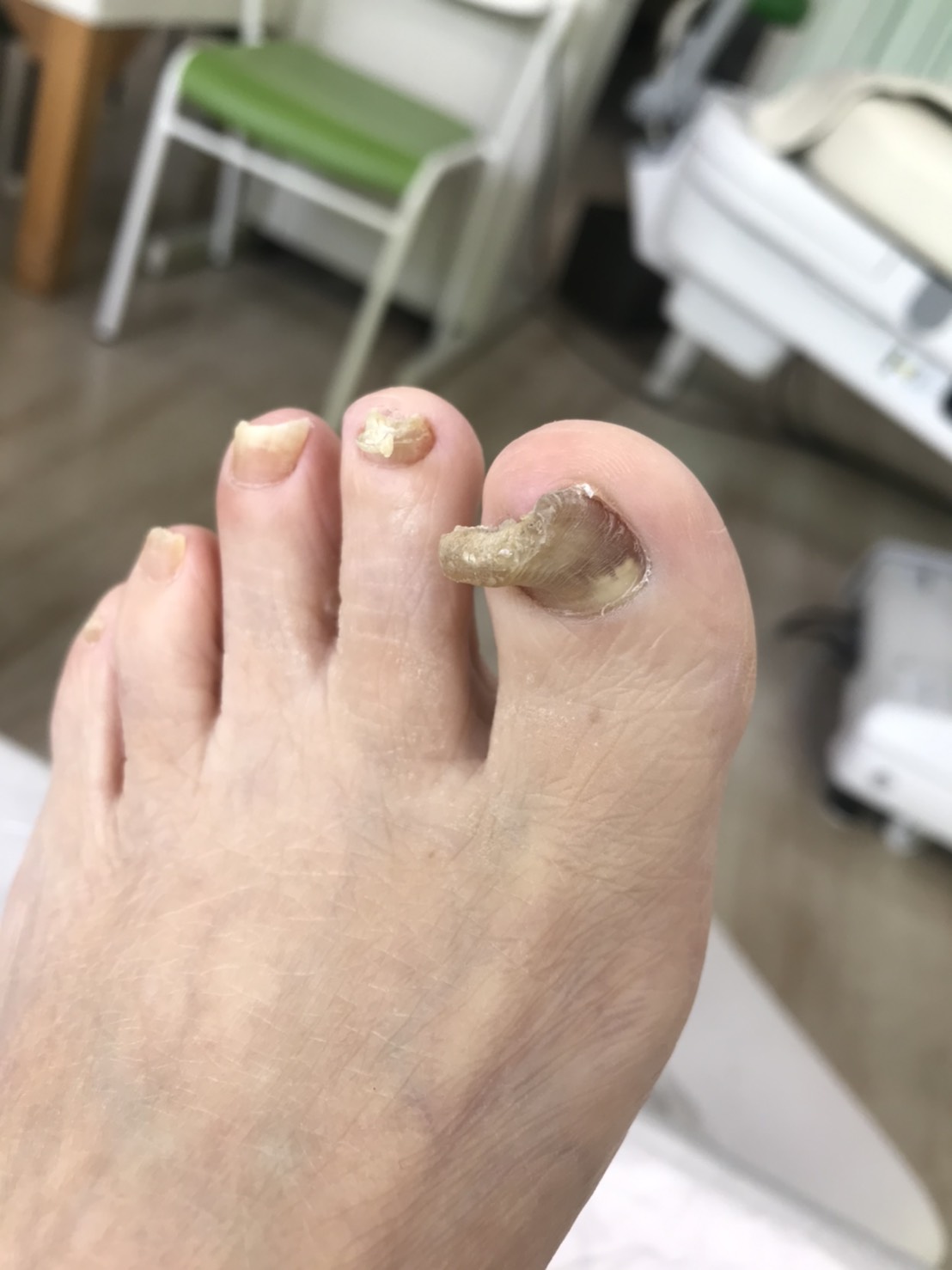 記事 痛くない！巻き爪･魚の目ケアのアイキャッチ画像