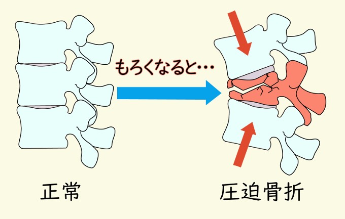 記事 気をつけたい種類の腰痛　３のアイキャッチ画像